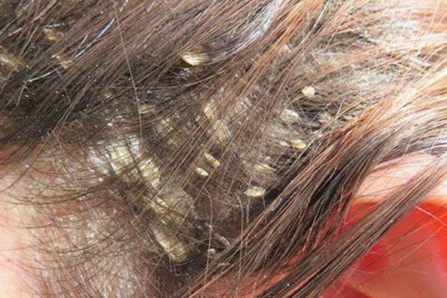La caspa no es contagiosa La caspa no es contagiosa