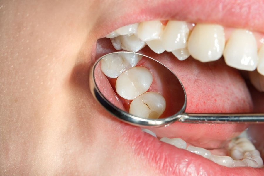 El azúcar en menos de 24 horas ya produce caries. El azúcar en menos de 24 horas ya produce caries.