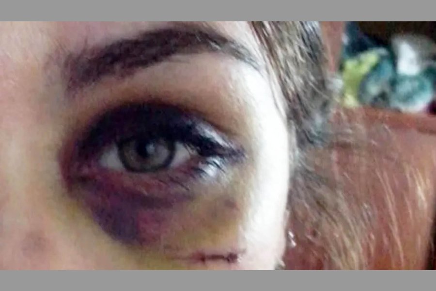 Sufrió lesiones en el rostro Sufrió lesiones en el rostro