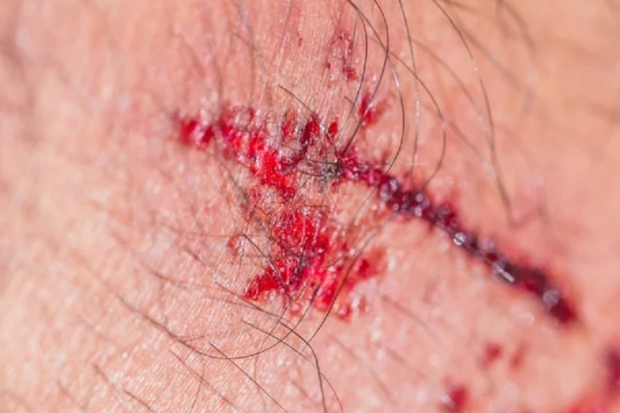 La victima se recupera de las heridas. La victima se recupera de las heridas.